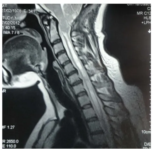 Figure 4 : L’IRM de contrôle 7 mois en postopératoire montrant l’absence de la grande citerne   etla persistance de la cavité syringomyélique