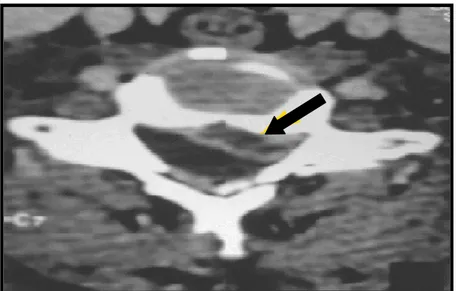 Figure 2 : coupe axiale d’une tomodensitométrie cervicale montrant une hernie discale  cervicale  
