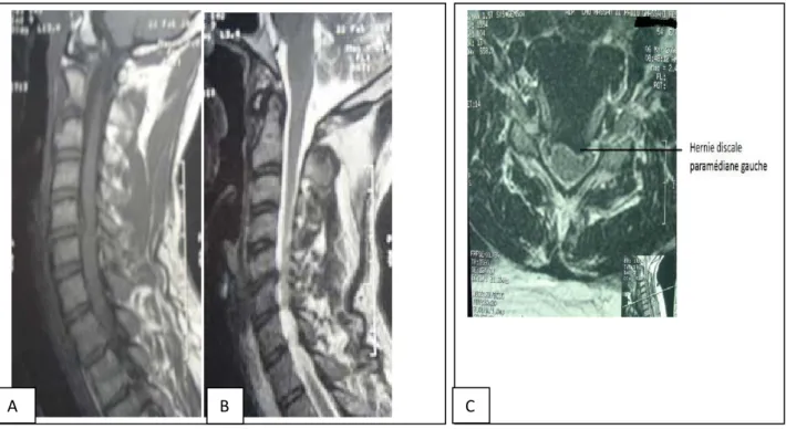 Figure 3 :   IRM cervicale en coupe sagittale pondérée T1 (A) et T2 (B) et en coupe axiale pondéré  T1 (C) montrant une HDC C5C6 
