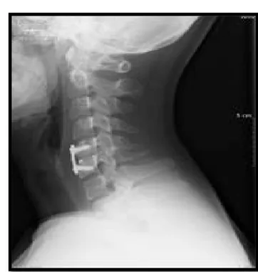 Figure 6: Radiographie cervicale de profil de contrôle faite après discectomie d’un seul  étage+arthrodèse par greffon iliaque+ostéosynthèse par plaque cervicale antérieure 