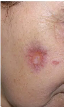 Figure 4 : sarcoïdes a petits nodules confluant  en plaque avec un aspect lupoide 