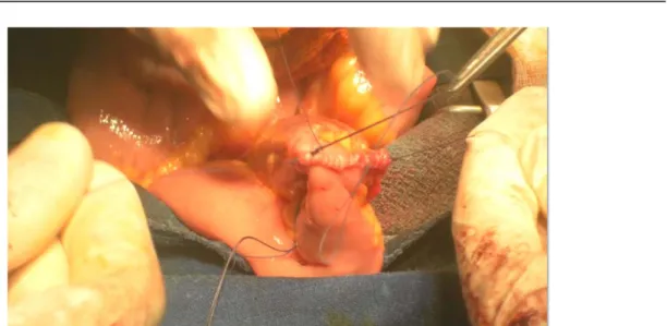 Figure n°10 : La fermeture manuelle de l’anastomose iléo-iléale termino-terminale.  (Service d’urologie, Hôpital Ibn Tofail de Marrakech) 