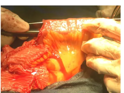Figure n°13 : L’introduction d’une pince à dissection   pour faciliter le procédé de détubulisation du segment iléal