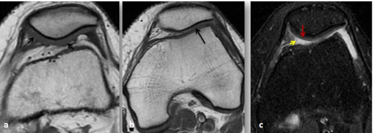 Figure 7:IRM en coupes axiales passant par le compartiment fémoro-patellaire en T1 FSE(a),  (b)   et en DP fat SAT FSE(c): 