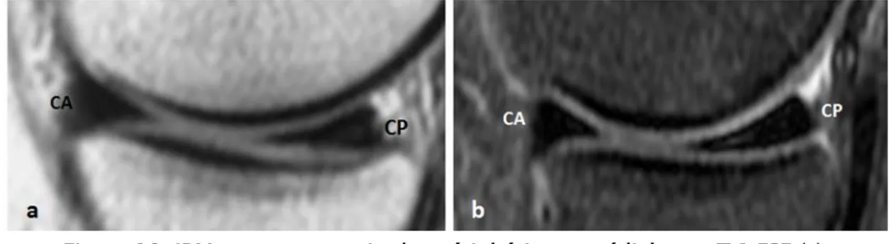 Figure 10: IRM en coupes sagittales périphériques médiales en T 1 FSE (a)   et DP fat SAT FSE(b)