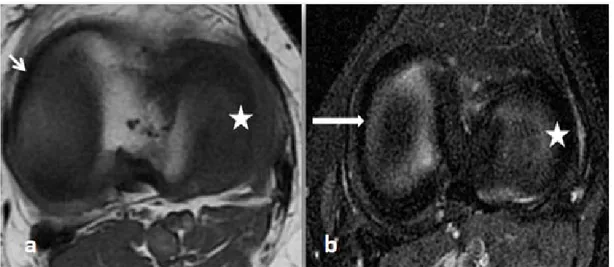 Figure 11 :IRM en coupes axiales en T 1 FSE (a) et  DP FAT SAT (b). ML: forme d'un croissant très  fermé (étoile)