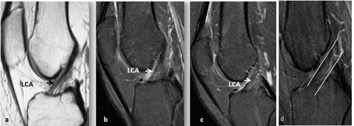 Figure 12 : IRM en coupes sagittales médianes en T1 FSE  (a) et DP FAT SAT (b, c, d).  LCA: Hyposignal modéré en T1 et T2, assez hétérogène, 