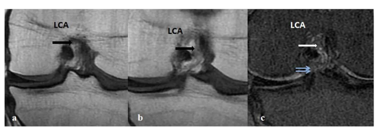 Figure 13:IRM en coupes coronales en T 1 FSE (a, b) et en DP FAT SAT (c). LCA : Insertion pré- pré-tibiale pré-spinale (flèches bleues)