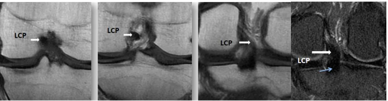 Figure 15:IRM en coupes coronales en T 1 FSE (a, b, c) et en DP FAT SAT(d).   Trajet du LCP: Trajet oblique sur les coupes coronales (flèches blanches)