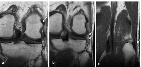 Figure 17: IRM en coupes coronales ( a, b, c) en T 1 FSE: LCL. 