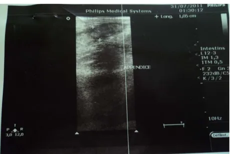 Figure 7 : échographie montrant l’image en faveur d’une appendicite aigue   chez une de nos patiente