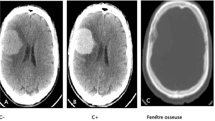 Figure 7 : TDM cérébrale en coupe axiale sans (A), avec injection du produit de contraste (B), et  la fenêtre osseuse (C) montrant un aspect en faveur d’un méningiome de la convexité pariétale  droite  