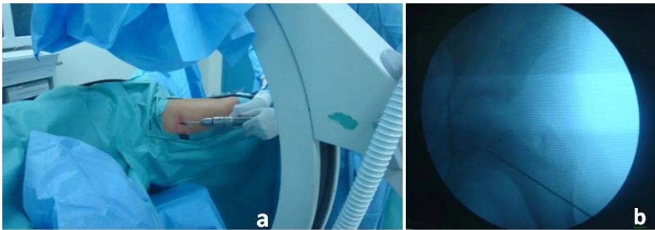 Figure 24. Broche guide à extrémité filetée introduite à l'aide du moteur (a) sous  contrôle de  l'amplificateur de brillance (b) à travers une incision cutanée