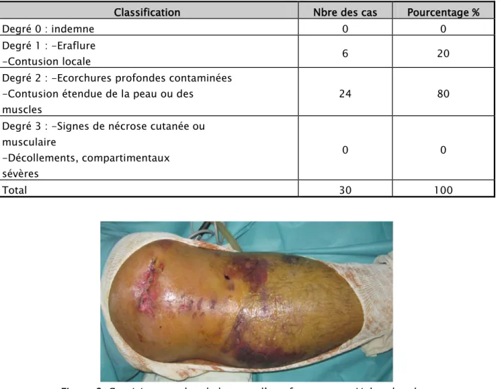 Tableau III : Répartition des contusions cutanées selon TSCHERN et GOTZEN 
