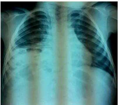 Figure 4 : Cliché thoracique de face cas N°1 :   clartés digestives lobe moyen droit. 