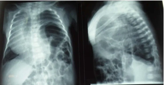 Figure 6 : Cas N°11 cliché thoracique  de face et de profil :  