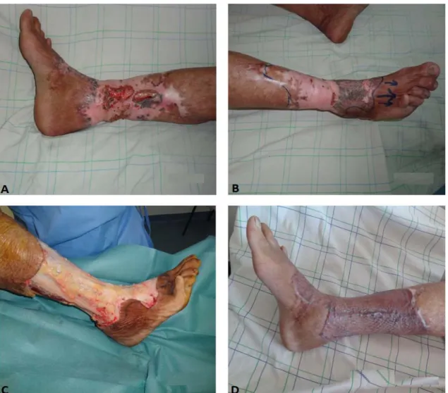 Figure VII: A : Ulcère de Marjolin de la jambe, sur une brûlure remontant à 25 ans chez un  patient âgé de 65 ans
