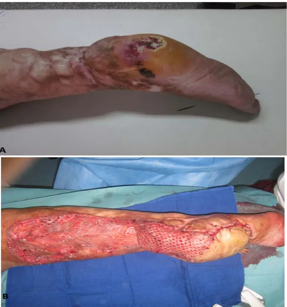 Figure VIII: A : Ulcère de Marjolin  du talon chez une patiente de 34 ans, 17 ans après la brûlure