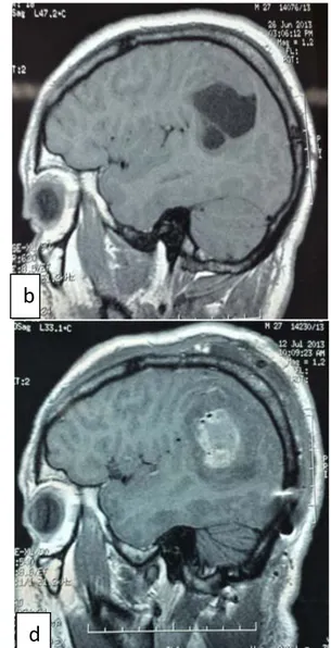 Figure 12 : a) , b) : IRM préopératoire d’un patient âgé de 27 ans admis initialement pour état de  mal convulsif