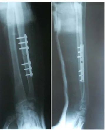 Figure n°17b: radiographie post-opératoire 