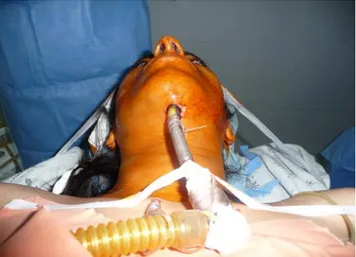 Figure 9b : Intubation sous-mentonnière 