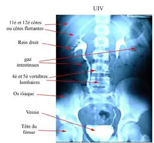 Figure 3 : UIV montrant les différentes portions de la voie excrétrice. 