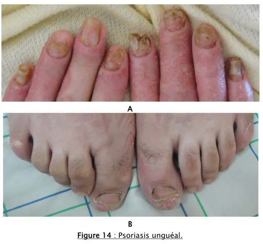 Figure 14 : Psoriasis unguéal. A : onycholyse + onychodystrophie. 
