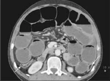 Figure 17 : Aspect tomodensitométrique d’une importante dilatation importante des anses grêles  comprimant le colon en périphérie (flèches)