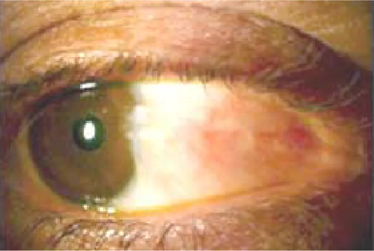 Figure n°:12 : Ptérygion vascularisé de l’œil droit avec début d’empiétement sur la cornée