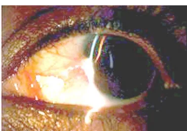Figure n°:19 : Image en fente fine d’un ptérygion de l’œil gauche. 