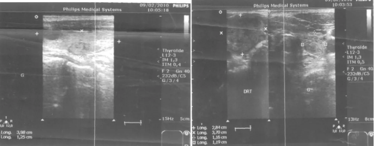 Figure n °6 : Radiographie du thorax de face refoulant la trachée  vers la droite [Iconographie service ORL du CHU Marrakech