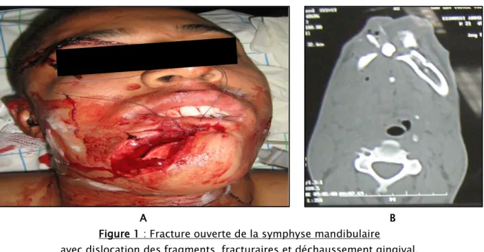 Figure 1 : Fracture ouverte de la symphyse mandibulaire 