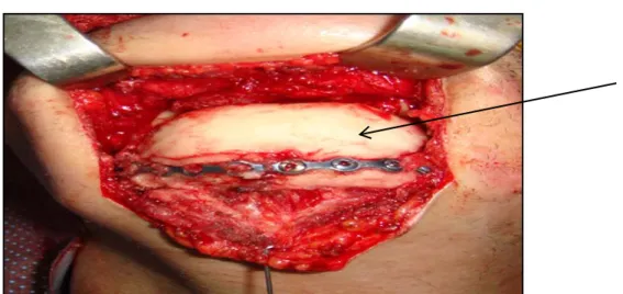 Figure 6 : Image peropératoire lors de la mise en place du Spacer (flèche). 