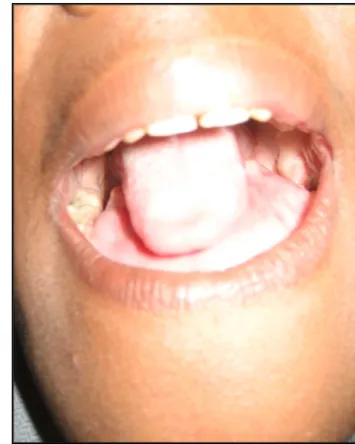 Figure 10: Aspect endobuccal de la tumeur  (refoulement de la langue 
