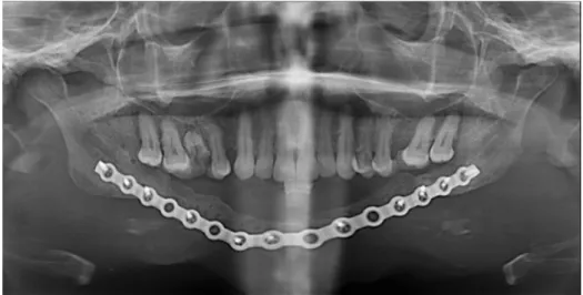 Figure 19 : OPT à 20 mois post-opératoire . 