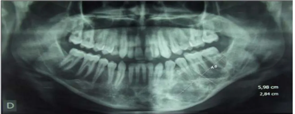 Figure 23: OPT objectivant une tumeur de la branche horizontale gauche. 