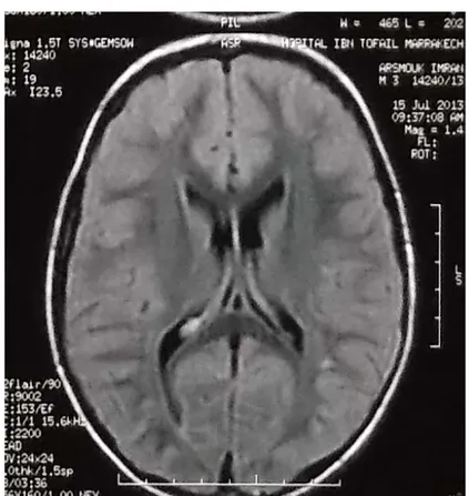 Figure 33 : image d’IRM montrant des lésions de substances blanches bipariétales 