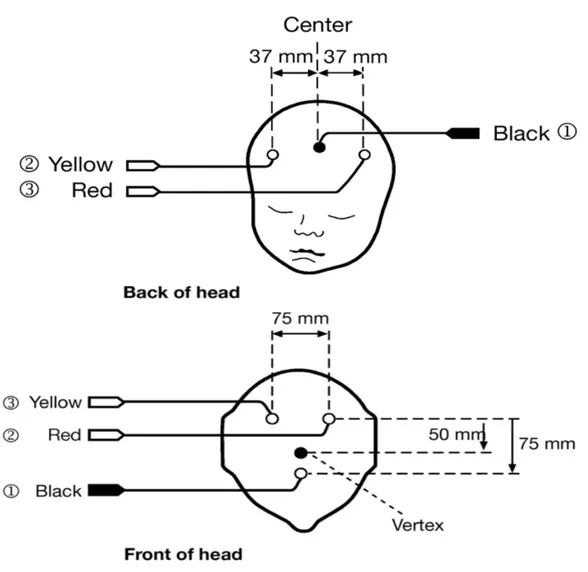 Figure 2. Les 2 Méthodes de montage des électrodes de l’Olympic CFM 6000 