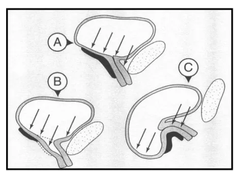 Fig. 22 : Rôle du soutènement sous-urétral dans la fermeture de l’urètre 