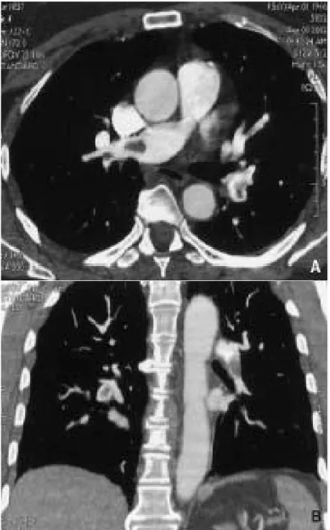 Figure 8: angioscanner réalisé pour suspicion d’embolie pulmonaire.  A. En coupe axiale on retrouve des lacunes endoluminales dans l’artère  pulmonaire droite et interlobaire gauche  correspondant à  des thrombi récents