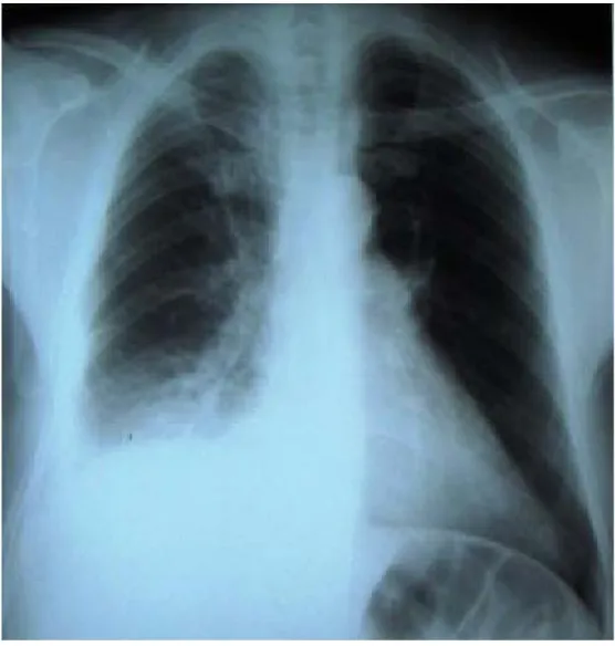 Figure 9 : Radiographie pulmonaire d’un de nos malades ayant une embolie  pulmonaire qui montre l’épanchement pleural droit 