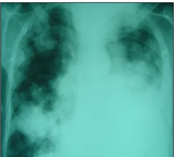 Figure 16: Radiographie pulmonaire : Métastases pulmonaire d’un patient   atteint d’un carcinome épidermoïde du sinus maxillaire gauche (2)