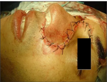Figure 21: Photographie de patient :   Incision paralatéronasale de Moure suturée (1)