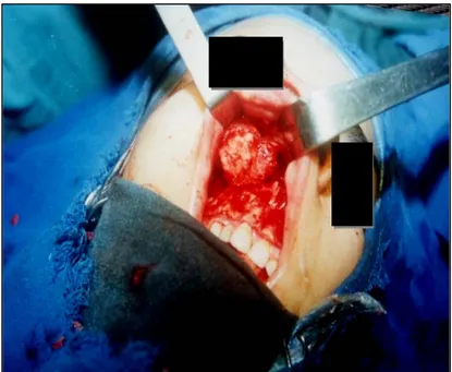 Figure 23: Photographie d’une patiente : Incision vestibulaire droite,   exérèse chirurgicale d’un chondrosarcome maxillaire droit (1)