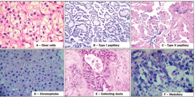 Figure 8 : Histologie des différents sous-types de carcinomes à cellules rénales. 