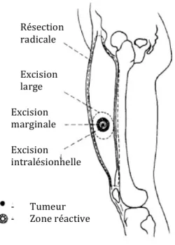Figure 1. Description des marges de résection chirurgicale selon Enneking et coll. 48 *Traduction faite par l’auteure de ce travail 