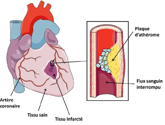 Figure 1-1  —  Artères  coronaires  irriguant  le  cœur.  La  plaque  d’athérosclérose  s’accumule  à  l’intérieur  de  la  paroi  réduisant  le  diamètre  de  la  lumière  vasculaire  où  circule le sang
