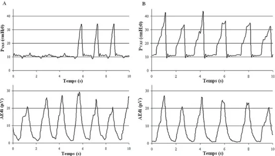 Fig. 2 Exemple représentatif de la synchronisation des tracés de pression des voies aériennes supérieures (PVAS) et de l ’activité élec- élec-trique du diaphragme (AEdi) d ’un enfant sous ventilation non invasive en mode aide inspiratoire (panel A) et en m