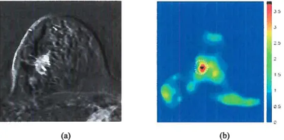 Figure 1.20: Image obtenue en MRI d’un sain dans lequel on remarque la présence d’une tumeur