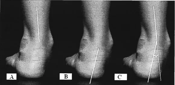 Figure 2.4. Subtalar j oint measurement: A) une bisecting distal third of the leg, B) line bisecting the calcaneus and C) hindfoot angle.